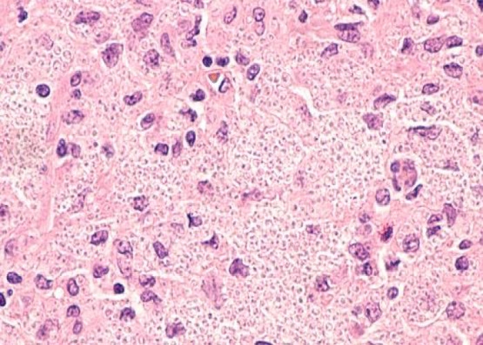 Histoplasmosis