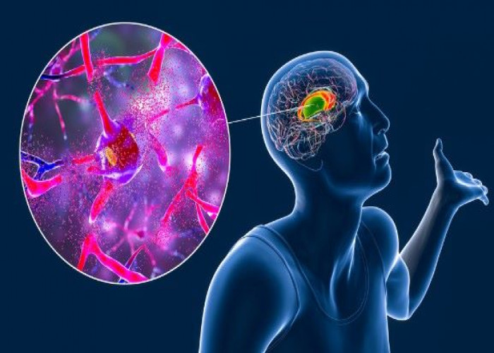 Huntington's disease