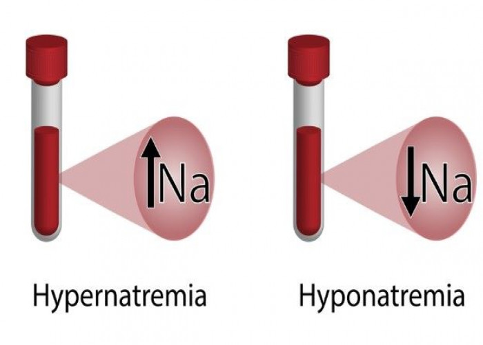 Hyponatremia