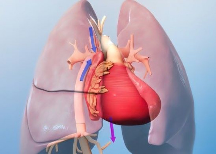 Hypoplastic left heart syndrome