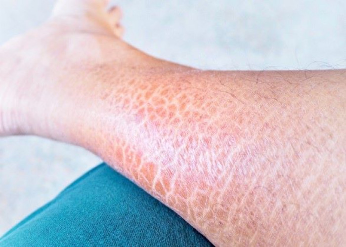 Ichthyosis vulgaris