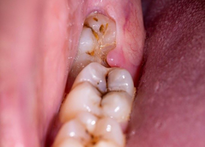 Impacted wisdom teeth