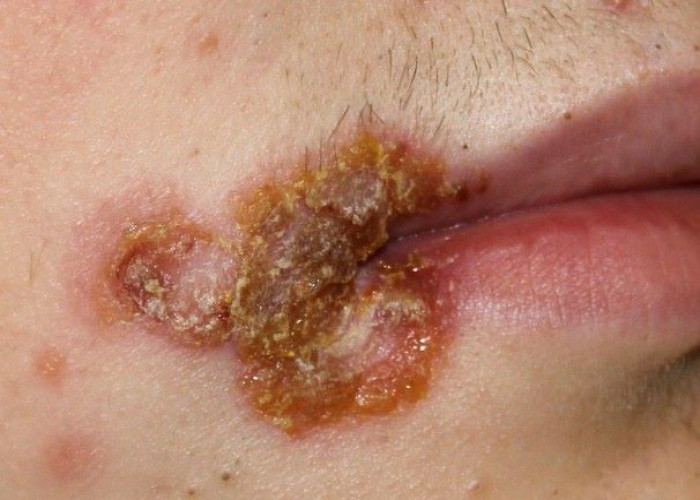 Impetigo