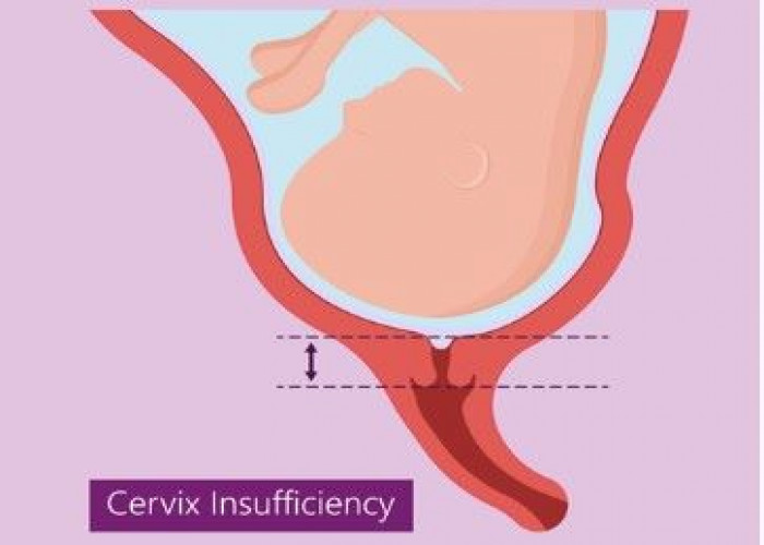 Incompetent cervix