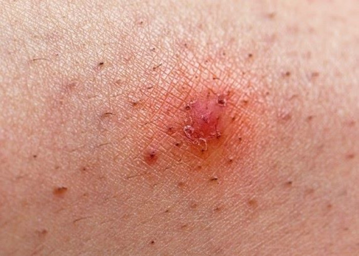 Ingrown hair