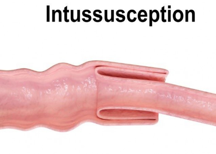 Intussusception