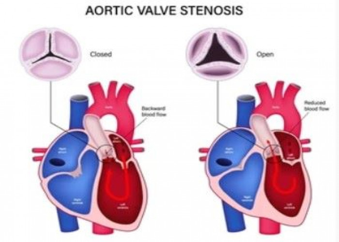 Aortic valve stenosis