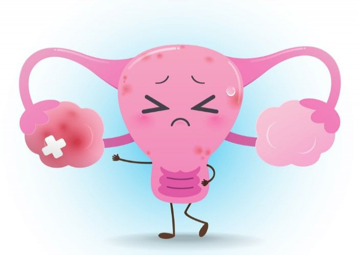 Uterine Inflamation (Cervicitis)
