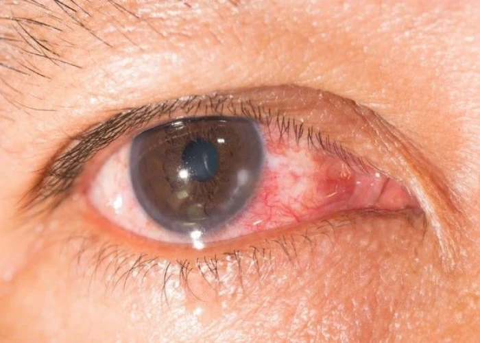 Keratitis