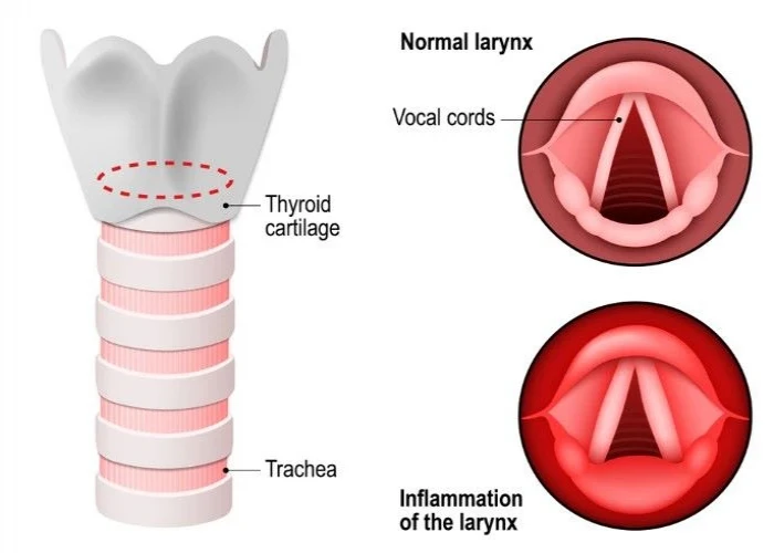 Laryngitis