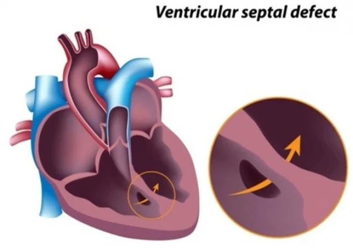 Left ventricular hypertrophy