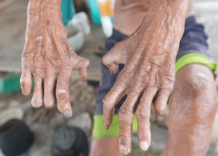 Leprosy