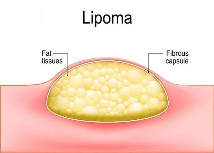 Lipoma