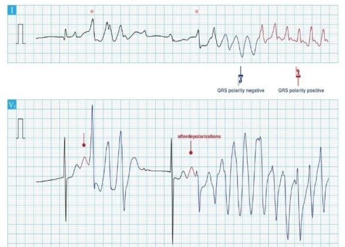 Long QT syndrome