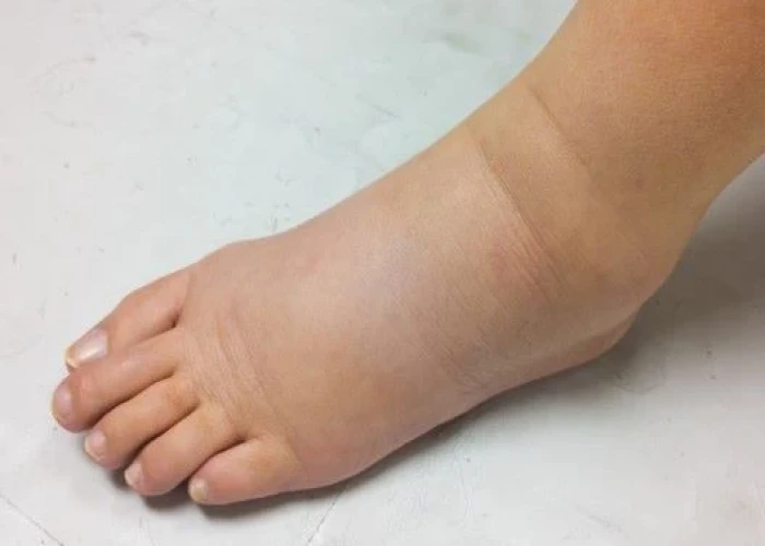 Lymphedema