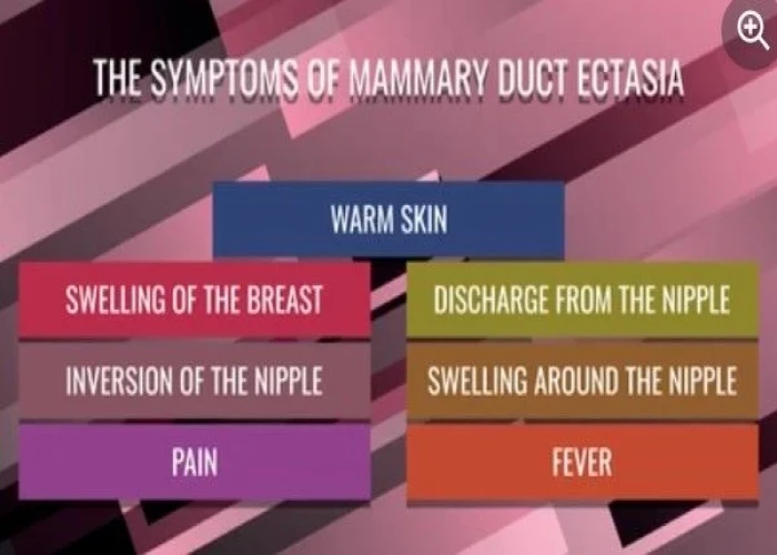 Mammary duct ectasia