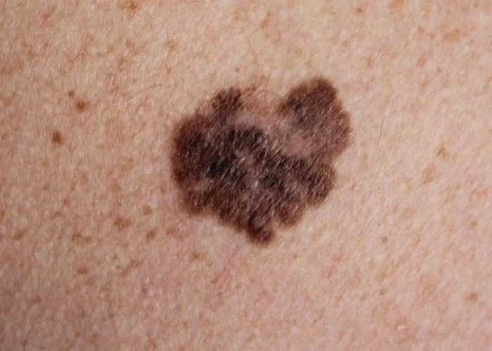 Melanoma