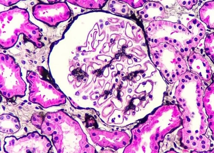 Membranous nephropathy