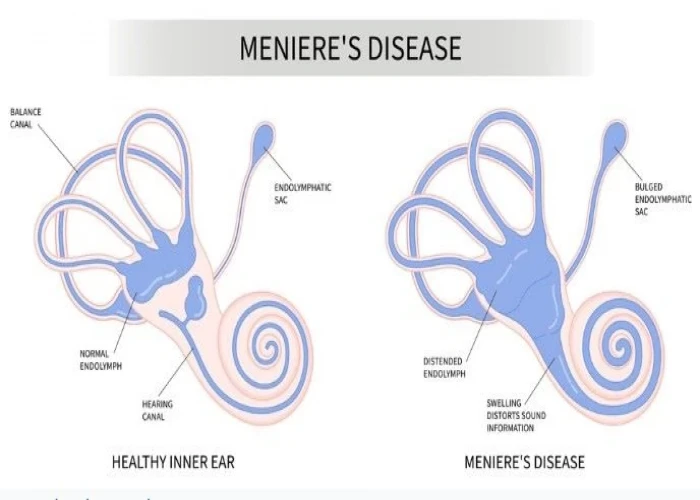 Meniere's disease