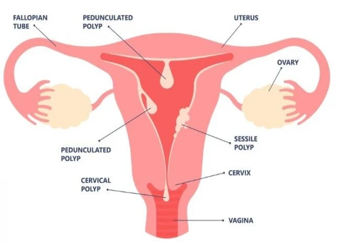 Menorrhagia (Heavy menstrual bleeding)