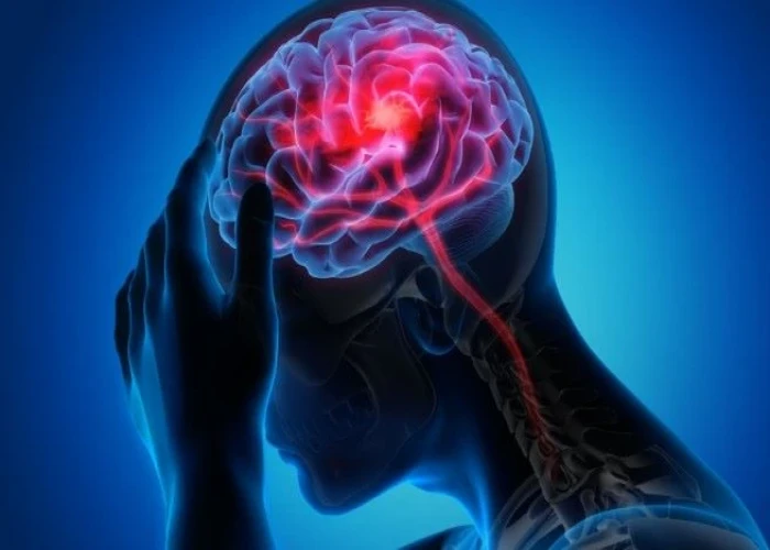 Migraine