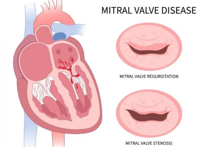 Mitral valve stenosis