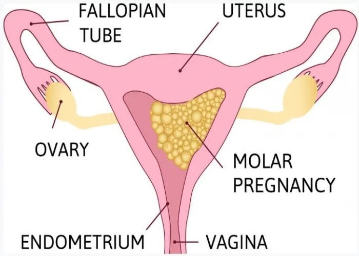 Molar pregnancy