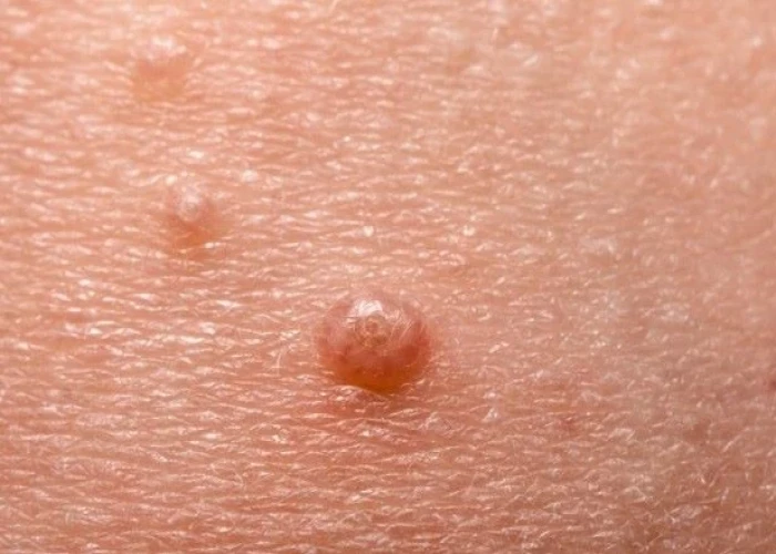 Molluscum contagiosum