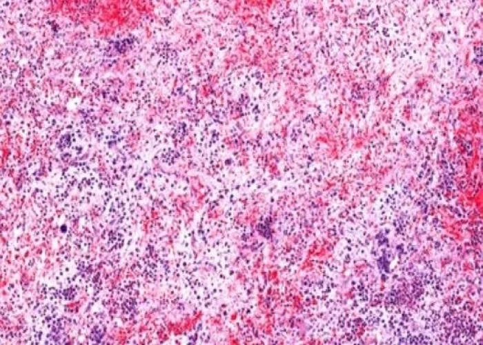 Myelofibrosis