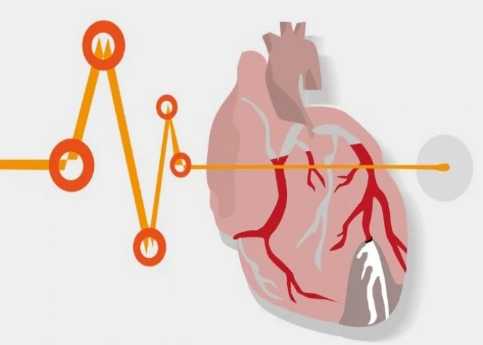 Myocardial ischemia