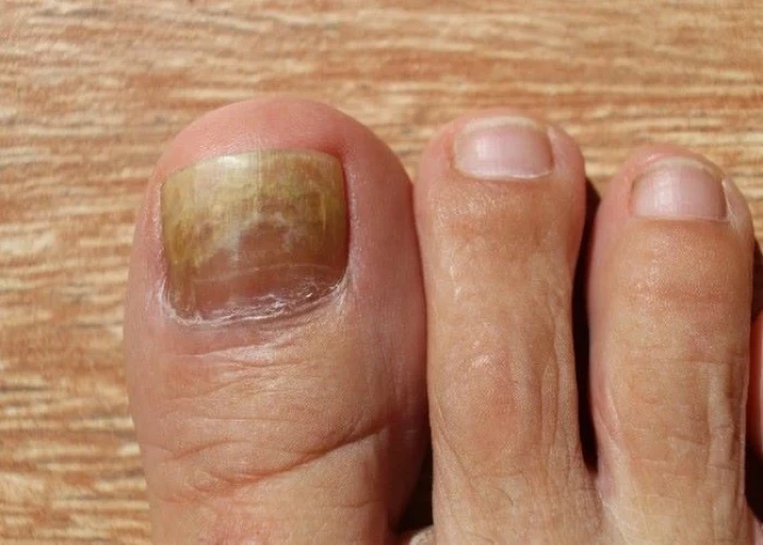 Nail fungus