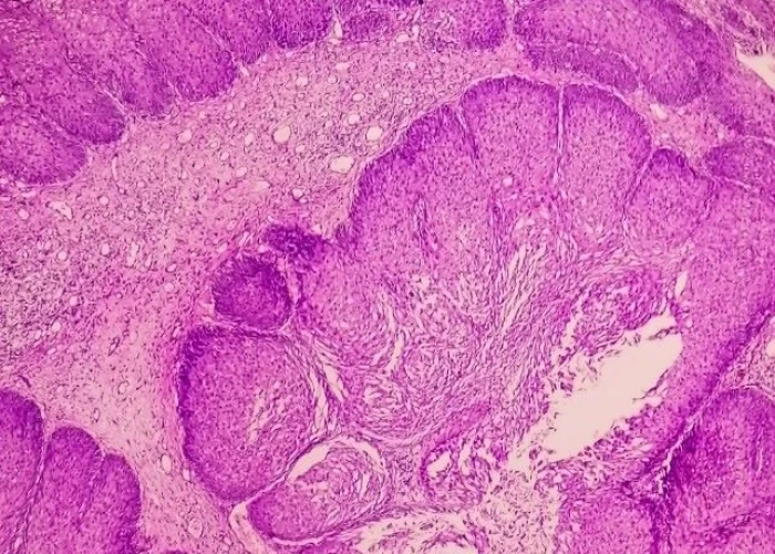 Nasal and paranasal tumors