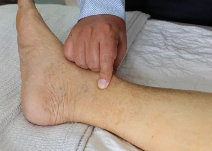Nephrotic syndrome