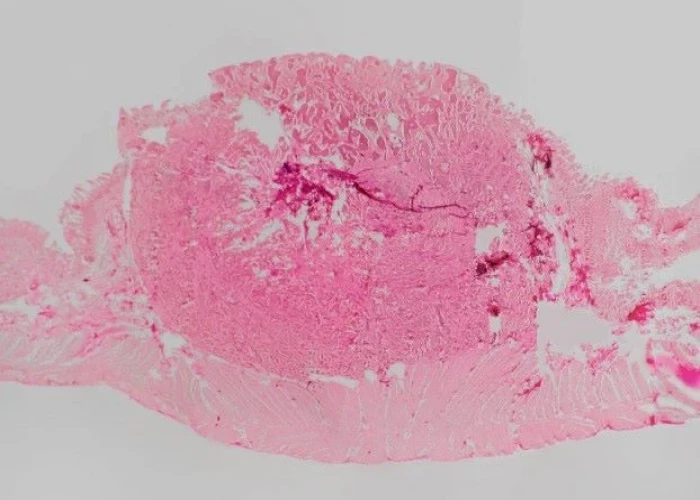 Neuroendocrine tumors