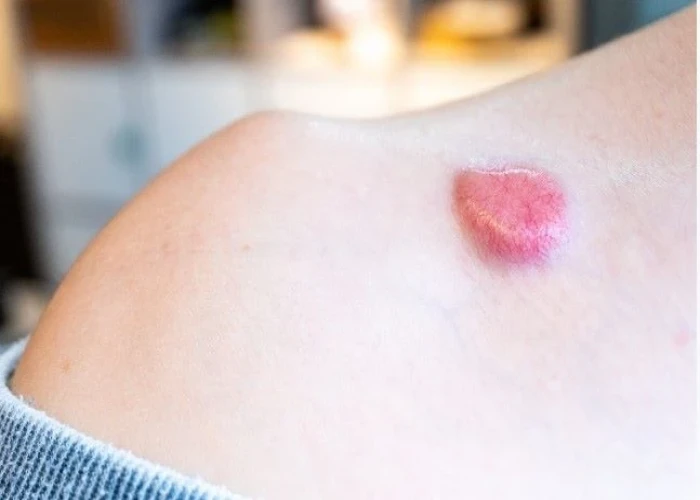 Nonmelanoma skin cancer