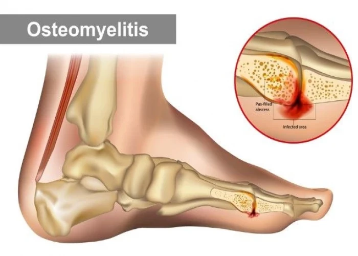 Osteomyelitis