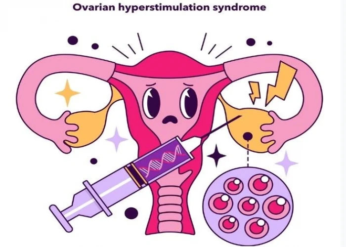 Ovarian hyperstimulation syndrome