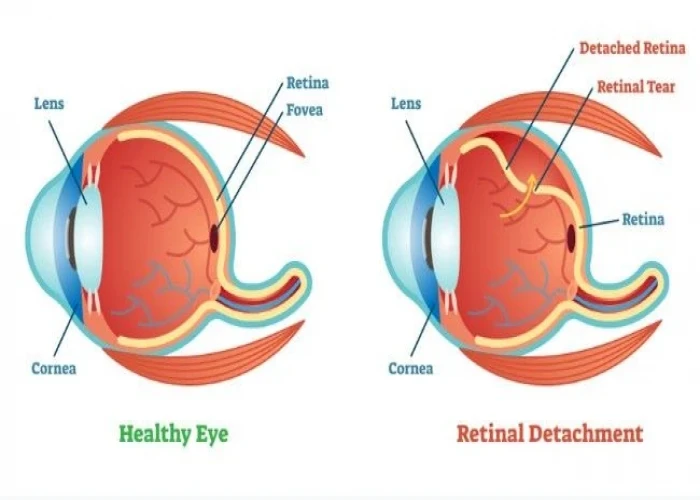 Retinal detachment