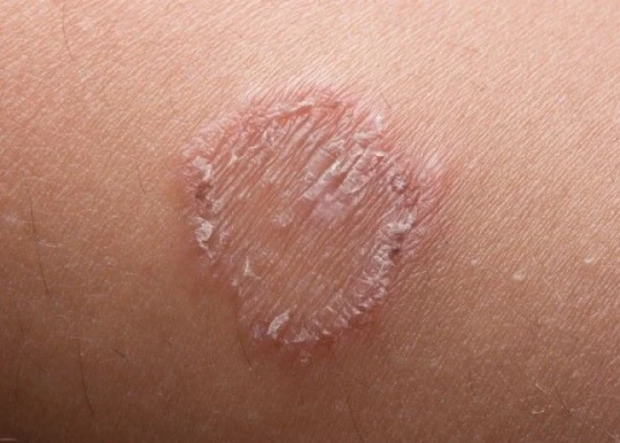 Ringworm (body)