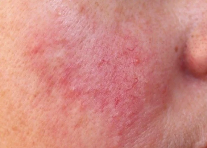 Rosacea