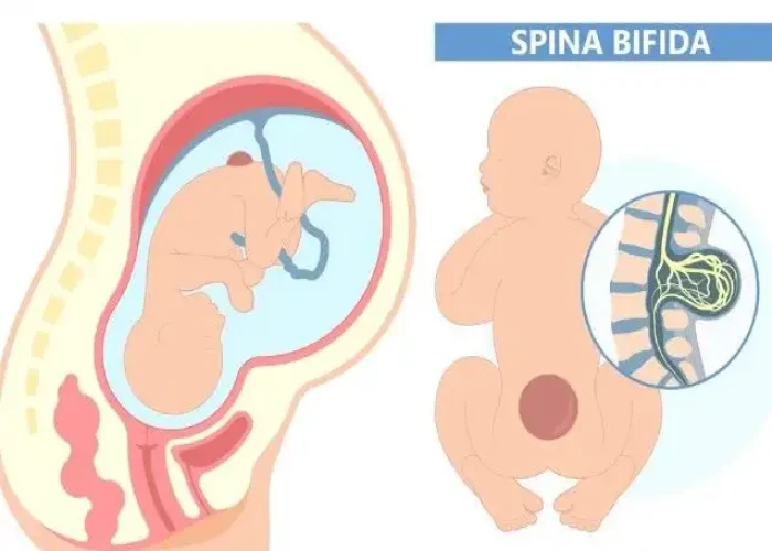 Sacral dimple