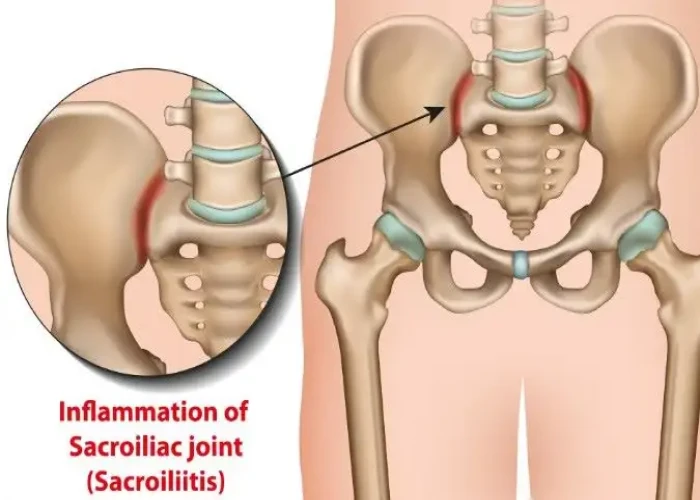Sacroiliitis