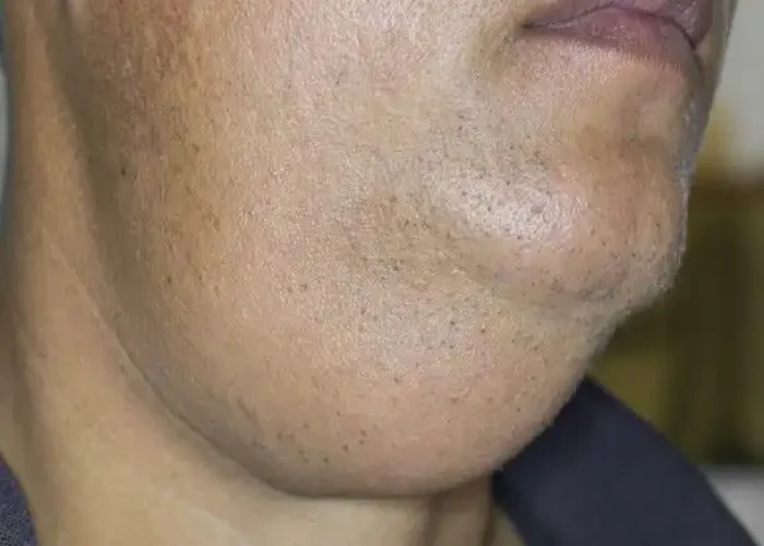 Salivary gland tumors