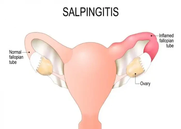 Salpingitis