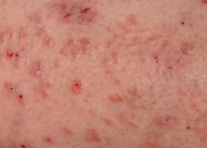 Scabies