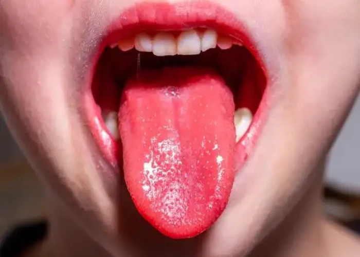 Scarlet fever