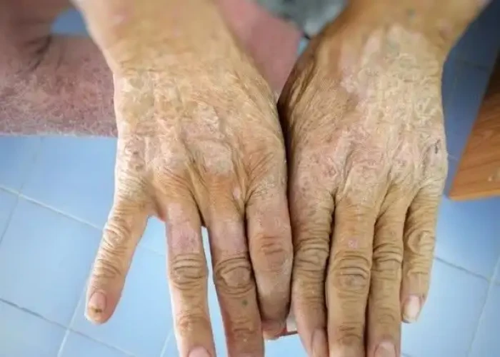 Scleroderma