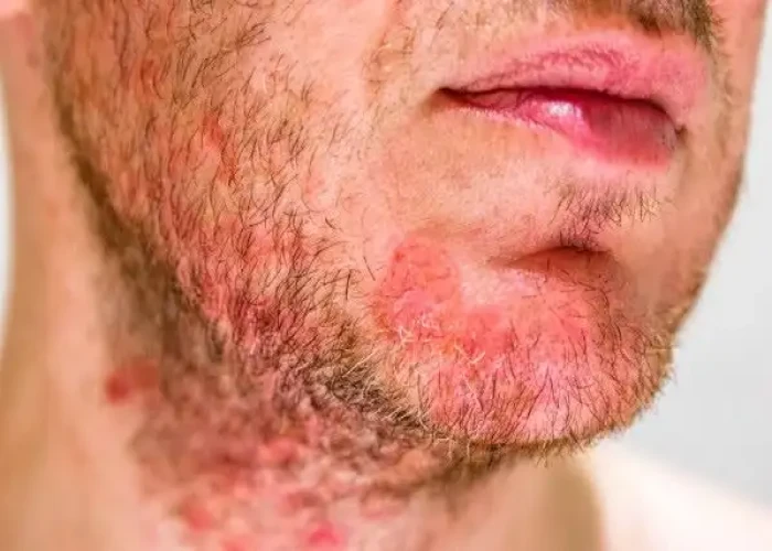 Seborrheic dermatitis