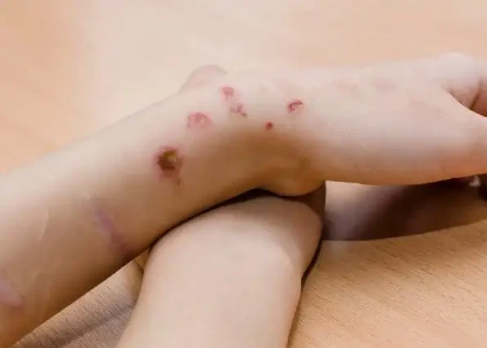 Self-injury