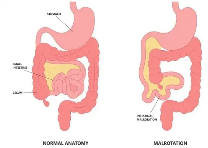 Short bowel syndrome